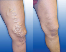 Load image into Gallery viewer, Medical Blue Light Therapy Laser Treatment Pen