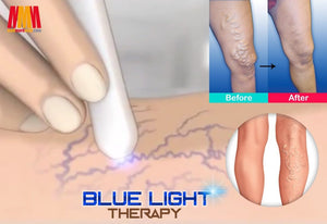 Medical Blue Light Therapy Laser Treatment Pen